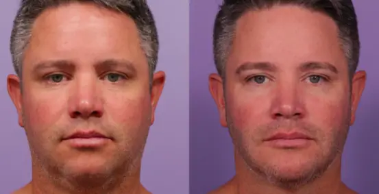 Buccal Fat Removal Before And After 