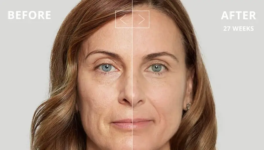 sculptra aesthetic before and after