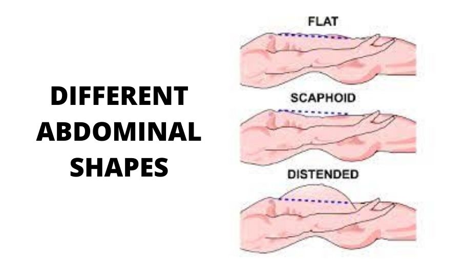 scaphoid shaped abdomen