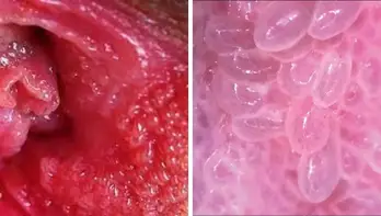 difference between vestibular papillomatosis and genital warts
