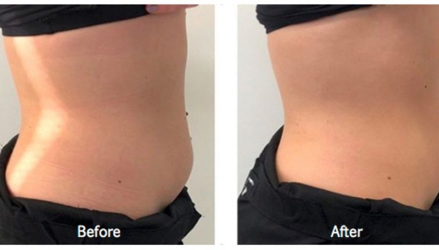 ultrasonic cavitation at home before and after