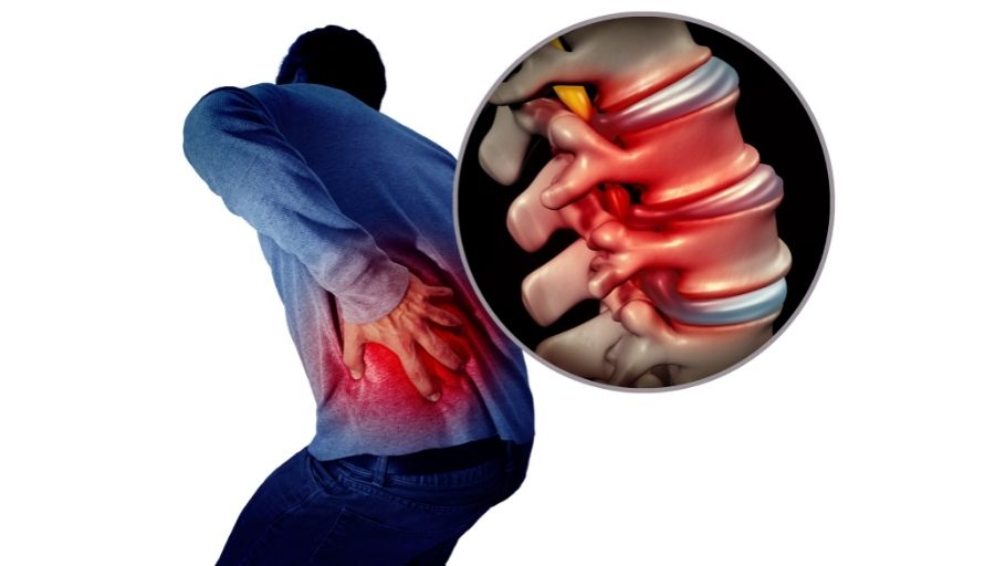 icd 10 low back pain with radiculopathy