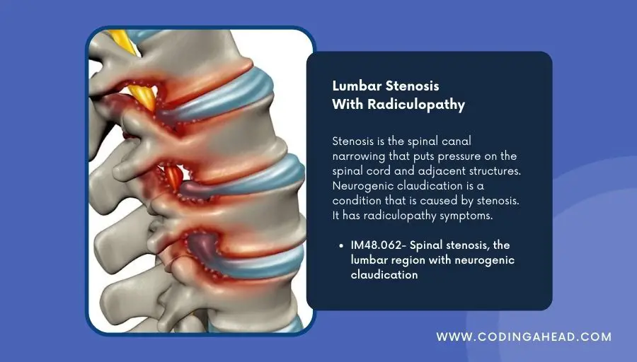 icd 10 code for lumbar spondylosis with radiculopathy
