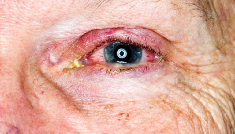 Insights into Ocular Tuberculosis: Understanding Four Types of Eye Infections