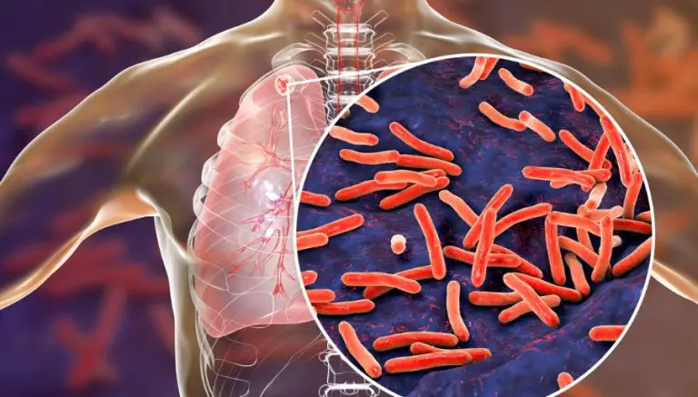 A Detailed Examination of Respiratory Tuberculosis: Types, Symptoms, Diagnosis, and Treatment